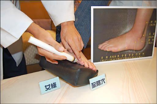 moxibustion-malposition-2